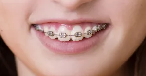Best Braces for Teens: Straight Talk on Smiles & Confidence