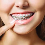 Can I Get Braces With Medical? Coverage Guide and Costs Can I Get Braces With Medical? Coverage Guide and Costs