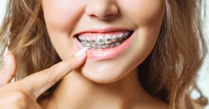 Can I Get Braces With Medical? Coverage Guide and Costs