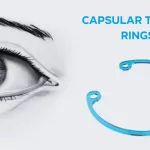 Capsular Tension Ring: Restore IOL Stability Now! Capsular Tension Ring: Restore IOL Stability Now!