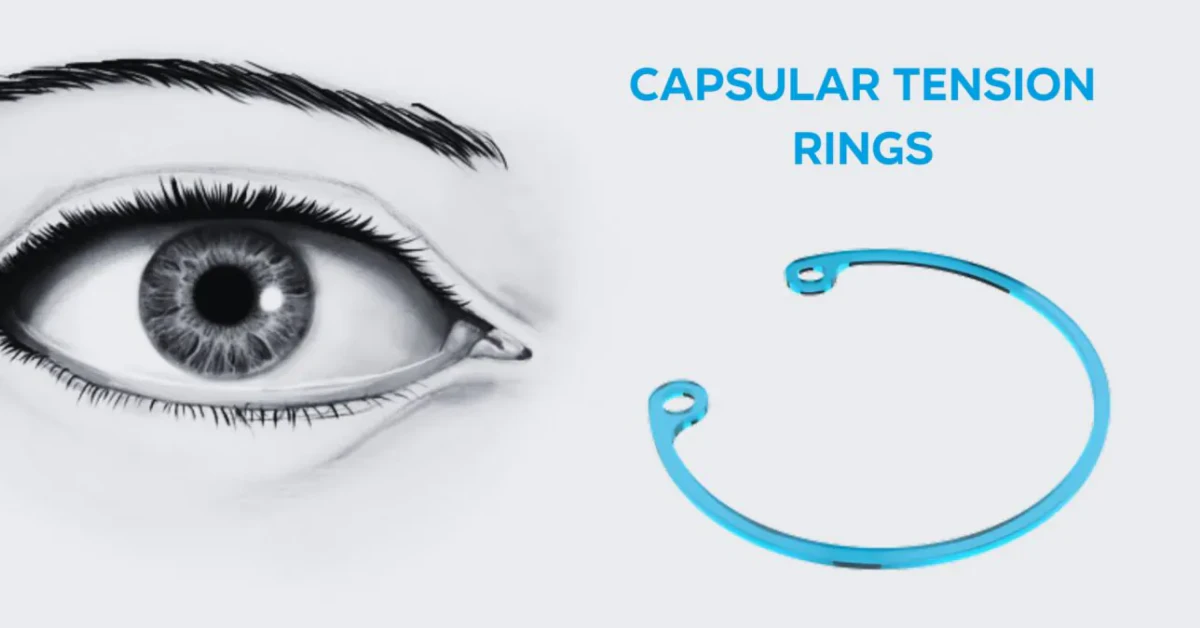 Capsular Tension Ring: Restore IOL Stability Now!