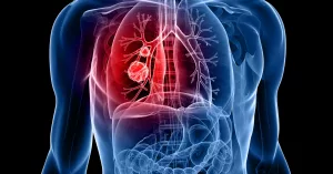 Study Highlights Chemoimmunotherapy for Lung Cancer in Stage III