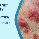 Can You Get Disability for Sarcoidosis? Steps and Advice