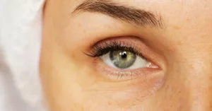 Dissolve Under Eye Filler: What You Need to Know