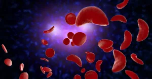 Gene Therapy for Sickle Cell: Cutting Stroke Risk, One Cell At a Time