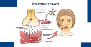 History of Myasthenia Gravis: Real Stories and Advances