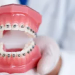 How Much Are Braces in San Diego? Costs & Hidden Surprises How Much Are Braces in San Diego? Costs & Hidden Surprises