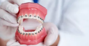 How Much Are Braces in San Diego? Costs & Hidden Surprises