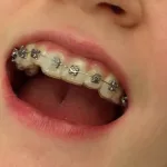 How Much Does a Broken Bracket Cost? Real Answers