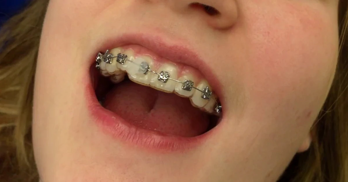 How Much Does A Broken Bracket Cost Fees Honest Answers