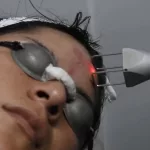 Laser CO2 Para Cicatrices: What You Need to Know Laser CO2 Para Cicatrices: What You Need to Know