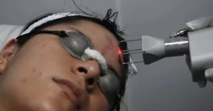 Laser CO2 Para Cicatrices: What You Need to Know Laser CO2 Para Cicatrices: What You Need to Know