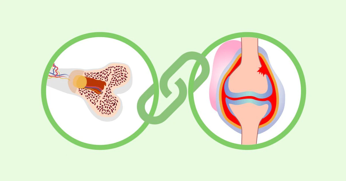 Malnutrition and Osteoarthritis: The Hidden Connection