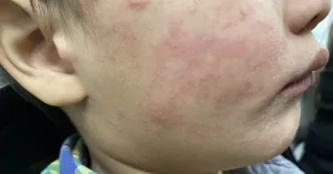 Michigan Announces Second Measles Outbreak as US Hits 1,227 Cases Michigan Announces Second Measles Outbreak as US Hits 1,227 Cases