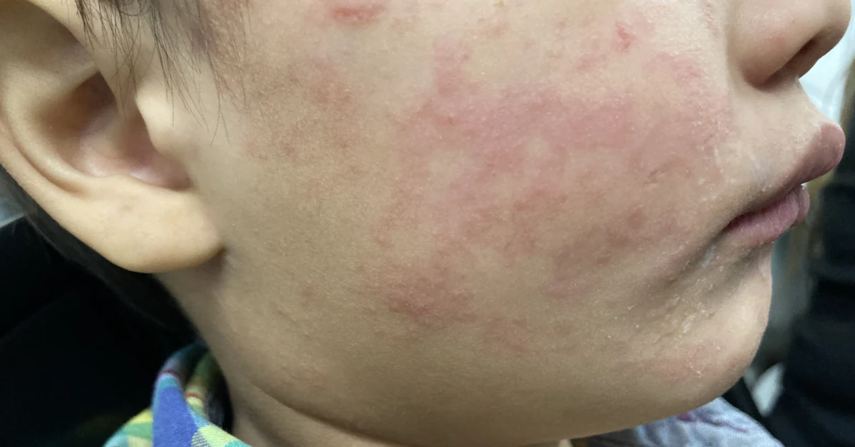 Michigan Announces Second Measles Outbreak as US Hits 1,227 Cases