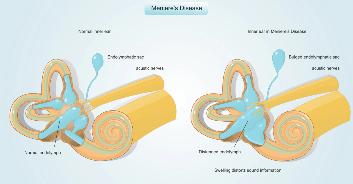 Hydrops MRI: Accurate Meniere Disease Diagnosis vs Vestibular Migraine
