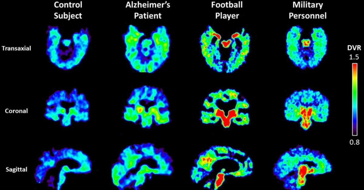 New PET Tracer Delivers High-Quality Brain Inflammation Imaging