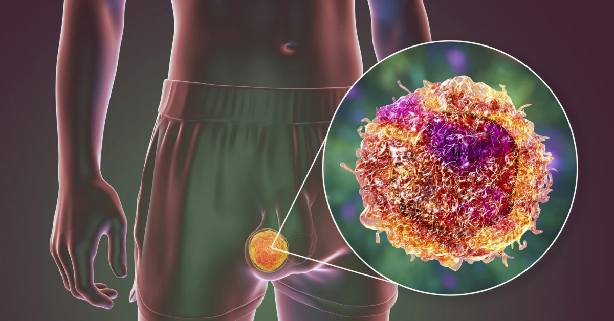 Testicular Cancer Awareness 2025: Spot Early Signs