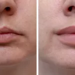 1/2 ml Lip Filler Before and After: This Results You’ll Get 1/2 ml Lip Filler Before and After: This Results You’ll Get