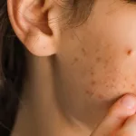 I Thought It Was Acne—Turns Out, I Was Wrong I Thought It Was Acne—Turns Out, I Was Wrong