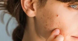 I Thought It Was Acne—Turns Out, I Was Wrong