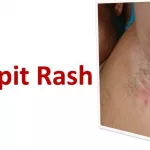 Armpit Rash: 12 Possible Causes and How to Treat Them Armpit Rash: 12 Possible Causes and How to Treat Them