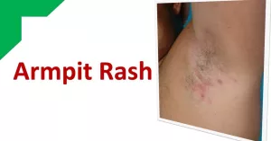 Armpit Rash: 12 Possible Causes and How to Treat Them