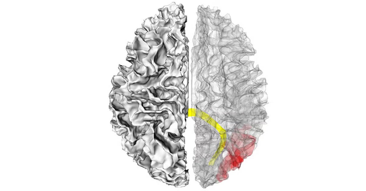 Autism Brain Mechanisms Linked to Schizophrenia Changes