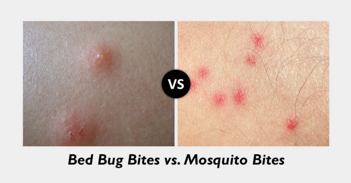 Bedbug Bites and Mosquito Bites: Spot the Signs, Stop the Itch