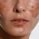 Best Foundation for Melasma: Flawless Cover-up Guide Best Foundation for Melasma: Flawless Cover-up Guide