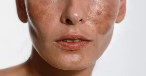 Best Foundation for Melasma: Flawless Cover-up Guide