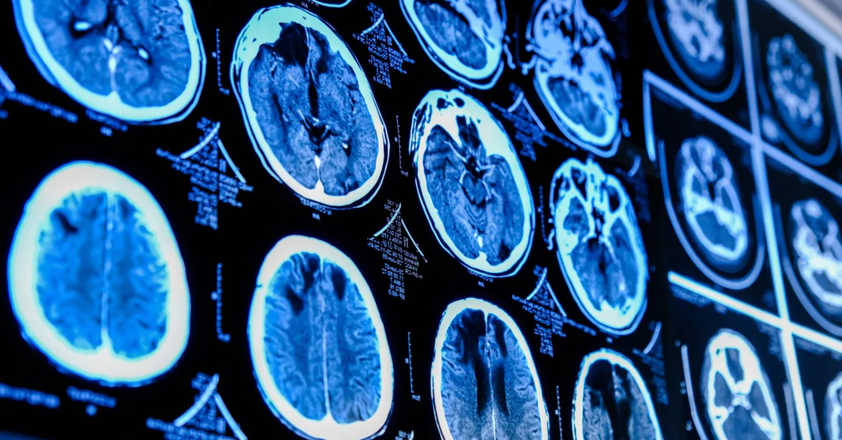 Biological Age Prediction – What You’re Missing