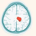 Brain Tumor Growth Patterns: What You Need to Know