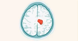 Brain Tumor Growth Patterns: What You Need to Know Brain Tumor Growth Patterns: What You Need to Know