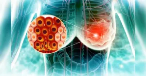 New Radiosering Could Make Breast Cancer Detection Quicker, More Undersyvel