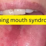 Burning Tongue Syndrome: Relieving Pain When Your Mouth Feels on Fire Burning Tongue Syndrome: Relieving Pain When Your Mouth Feels on Fire