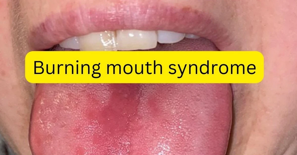 Burning Tongue Syndrome: Relieving Pain When Your Mouth Feels on Fire