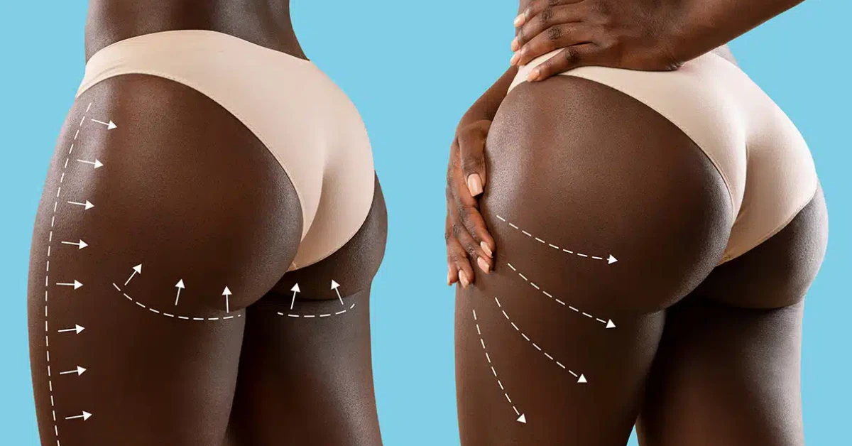 Butt Implants vs BBL: Which One Fits Your Body?