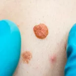 Cancerous Skin Tags: What You Need to Know Cancerous Skin Tags: What You Need to Know