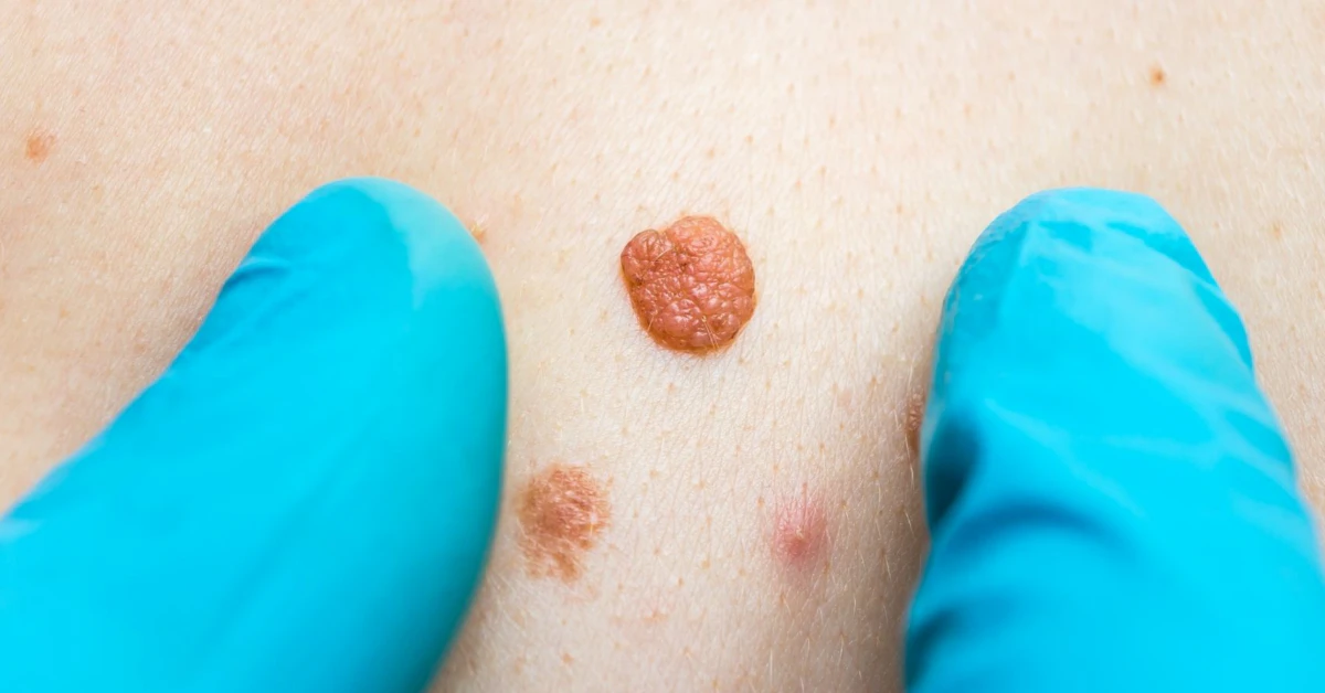 Cancerous Skin Tags: What You Need to Know