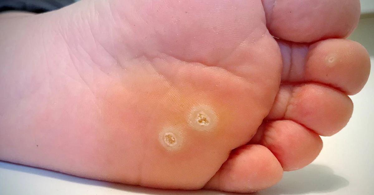 What Causes Warts? (It’s Not What You Think)