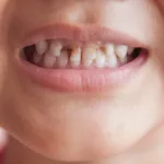 Finding the Root of Child Tooth Decay – and How to Stop It Finding the Root of Child Tooth Decay – and How to Stop It