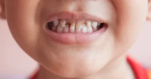 Finding the Root of Child Tooth Decay – and How to Stop It Finding the Root of Child Tooth Decay – and How to Stop It