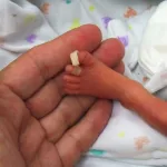 CMV Birth Defects: A Hidden Threat in Pregnancy