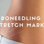 Microneedling for Stretch Marks? Here’s What Works