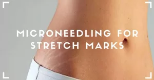 Microneedling for Stretch Marks? Here’s What Works