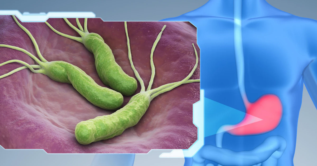 Common Bacteria Linked to Millions of Stomach Cancer Cases