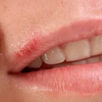 Herpes Virus Treatment: Smooth Moves and Game Changers