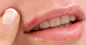 Herpes Virus Treatment: Smooth Moves and Game Changers