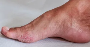 Home Remedies for Athlete’s Foot That Actually Work